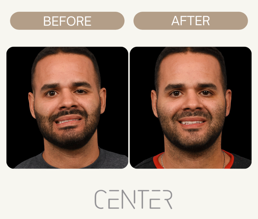 Before and After Facial Reanimation