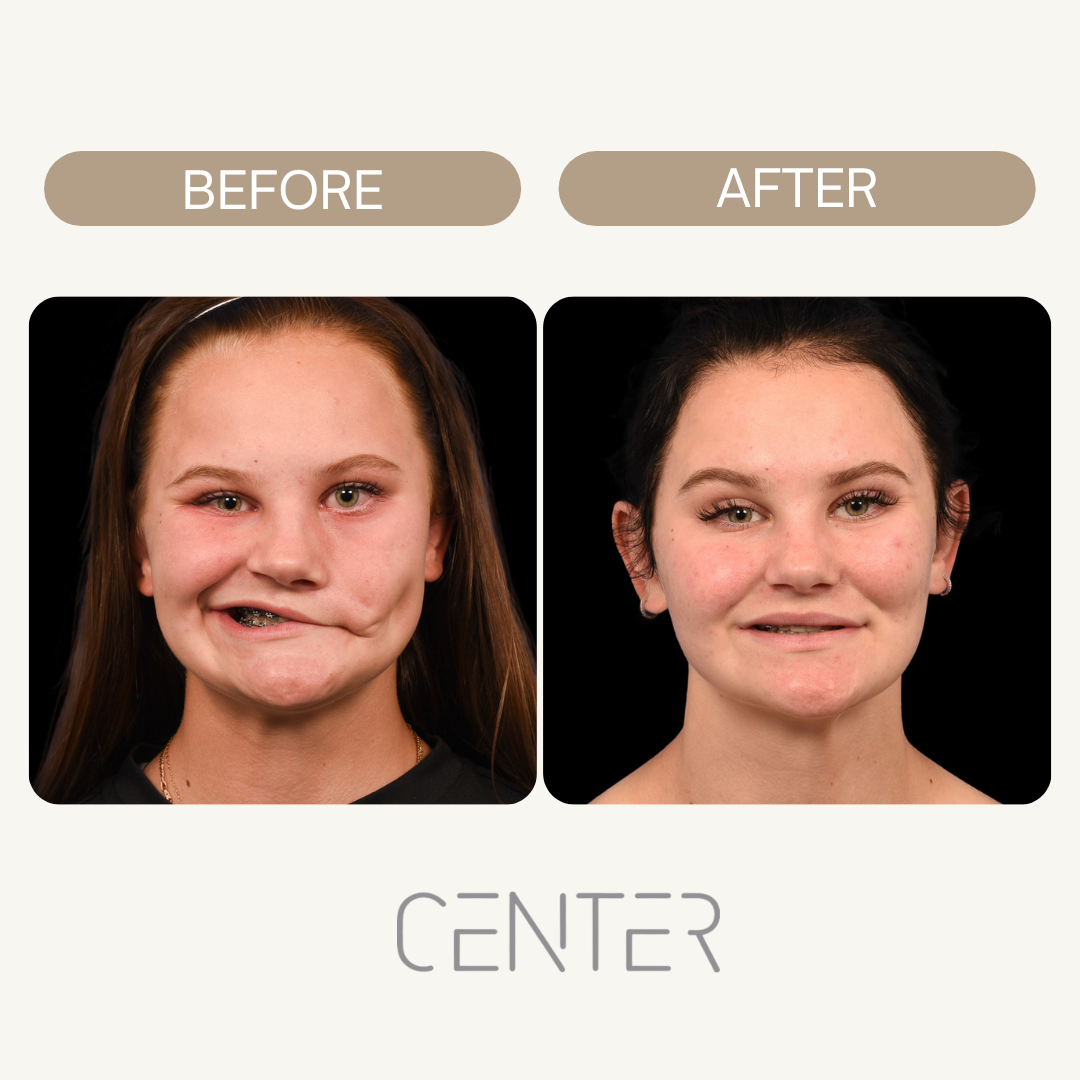 before and after picture of girl with bell’s palsy
