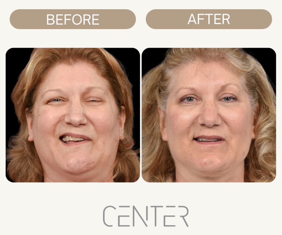 Before and After Facial Reanimation