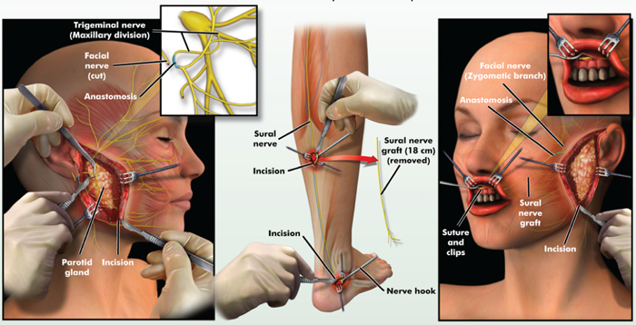  masseter to trigeminal facial nerve transfer 