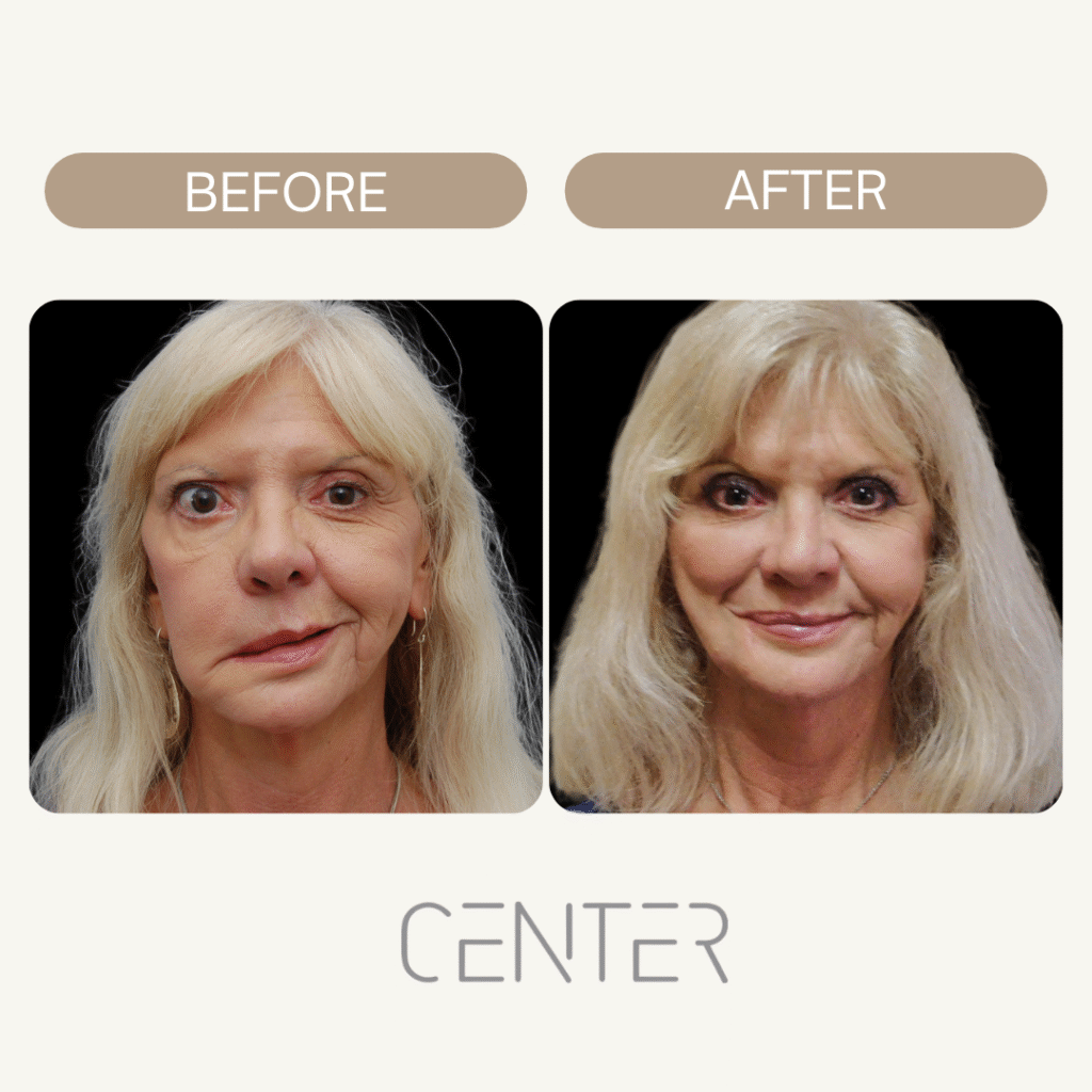 Before and After woman fillers