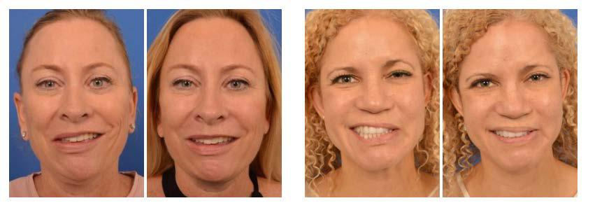 before and after facial paralysis
