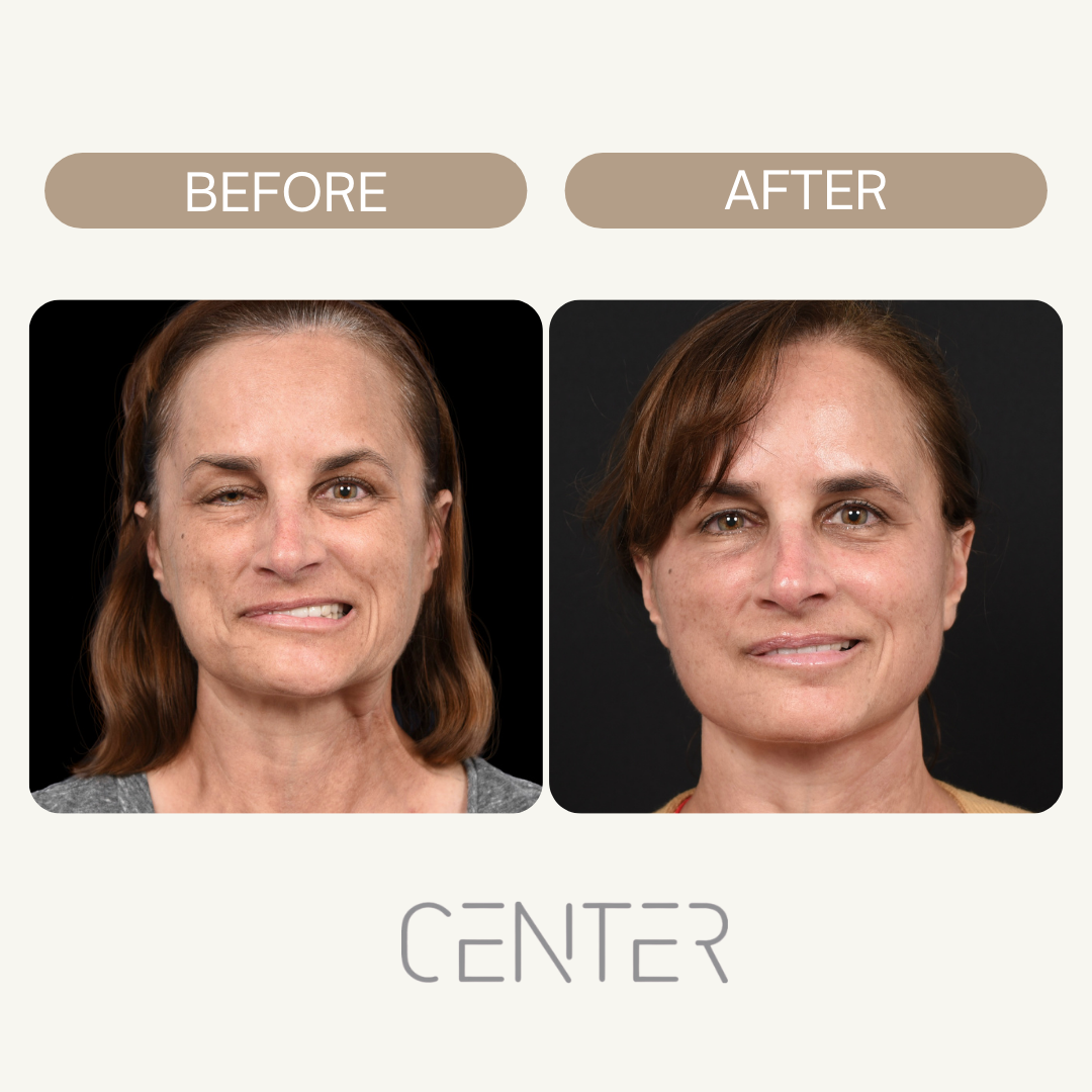 DAO Resection Surgery before and after