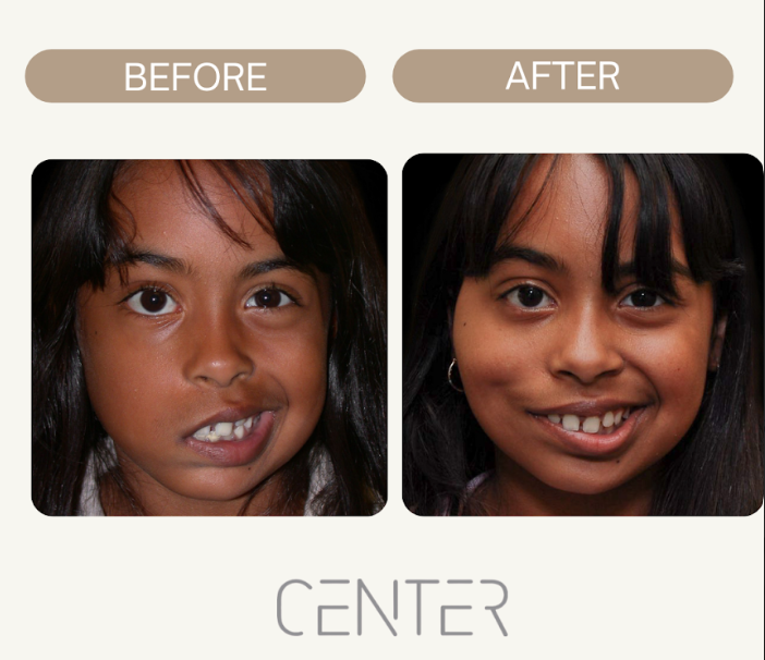 Facial reanimation before and after results