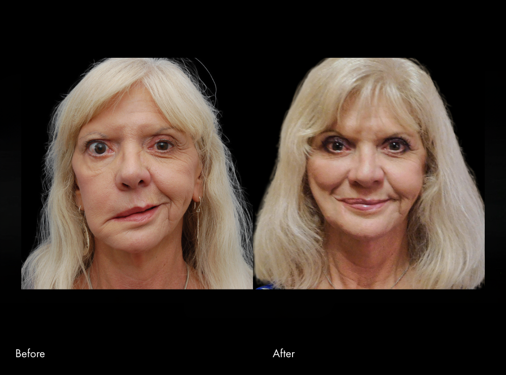 Masseter Nerve Transfer before and after