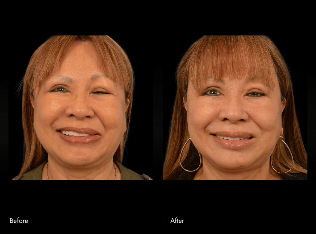 Tenth facial reanimation surgery before and after
