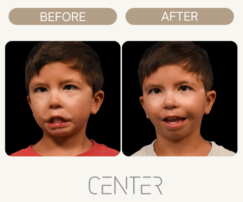 Before and After facial reanimation of a child