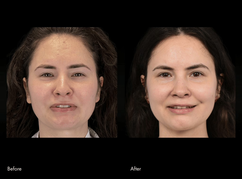 facial reanimation surgery before and after of a woman