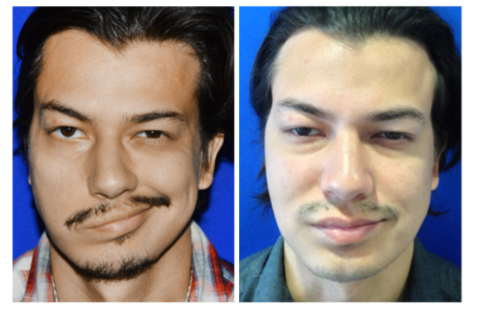 facial reanimation surgery before and after Facial nerve transfer