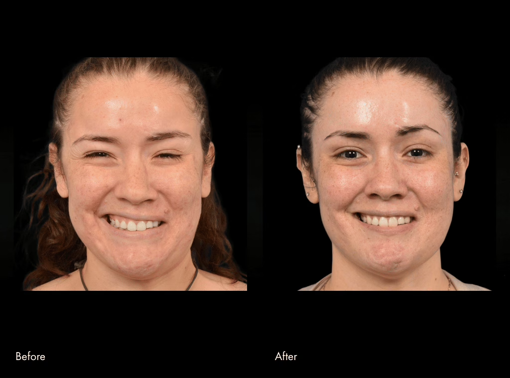Sixth facial reanimation surgery before and after