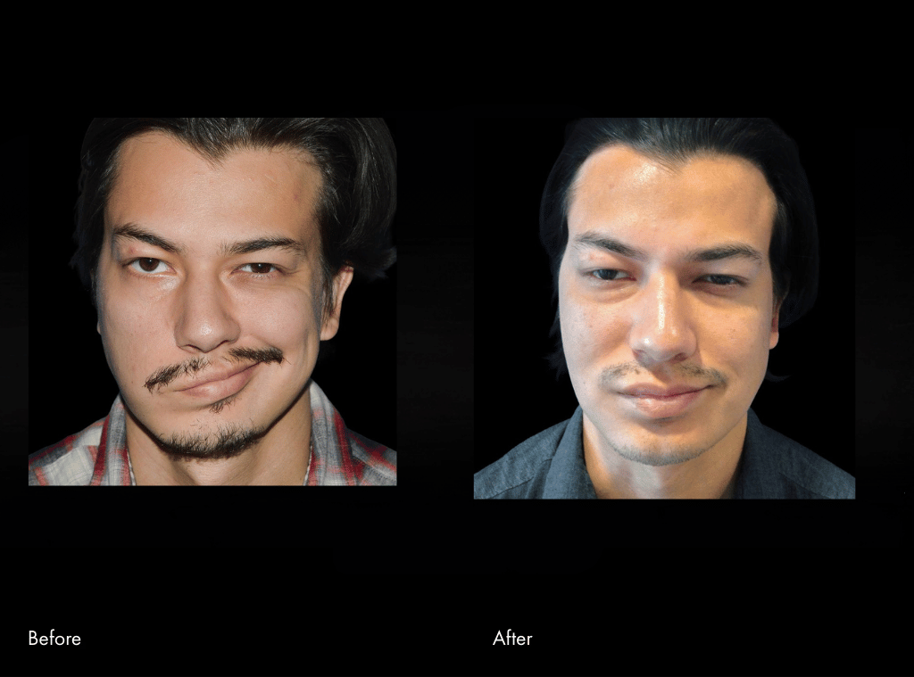 Masseter Nerve Transfer before and after