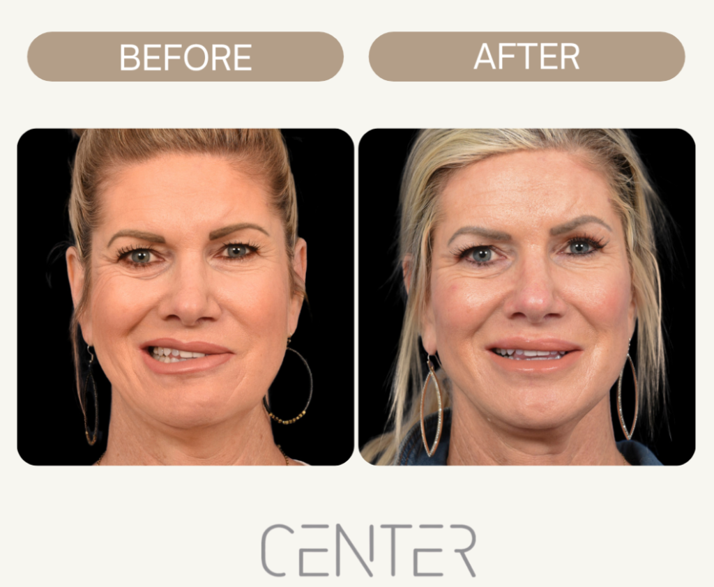 Before and After work of Sr Azizzadeh