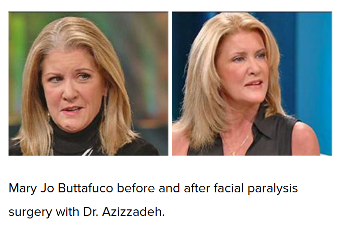 facial reanimation surgery before and after facial paralysis treatment