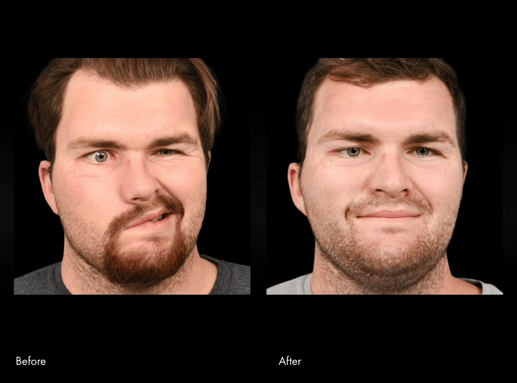 facial reanimation surgery before and after of a guy