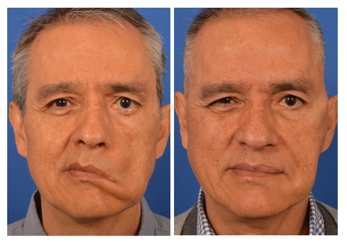 facial reanimation surgery before and after masseter nerve transfer