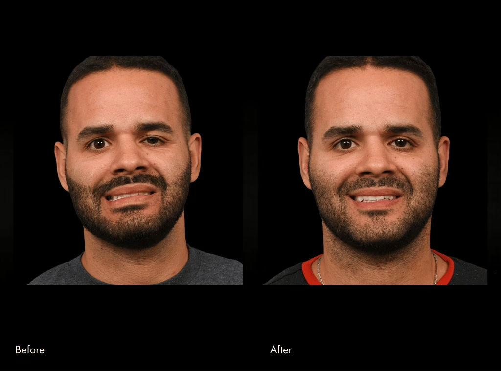 Second facial reanimation surgery before and after