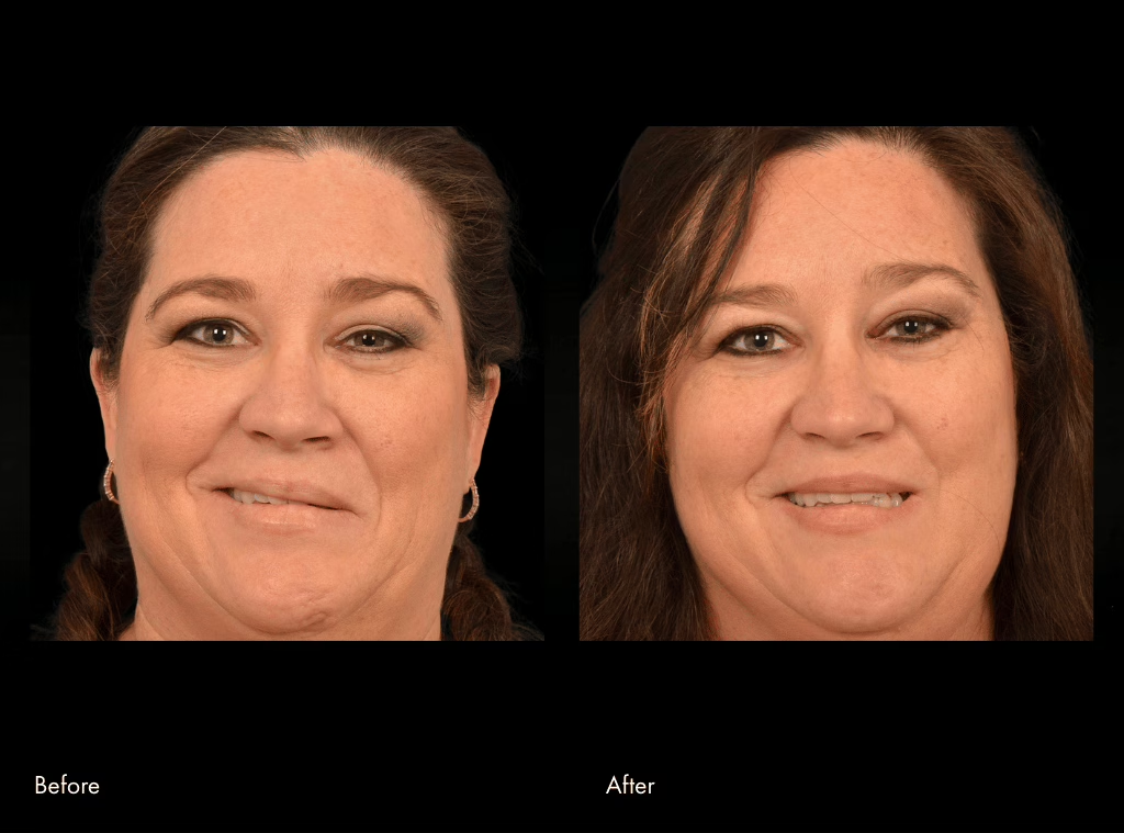 Fifth facial reanimation surgery before and after