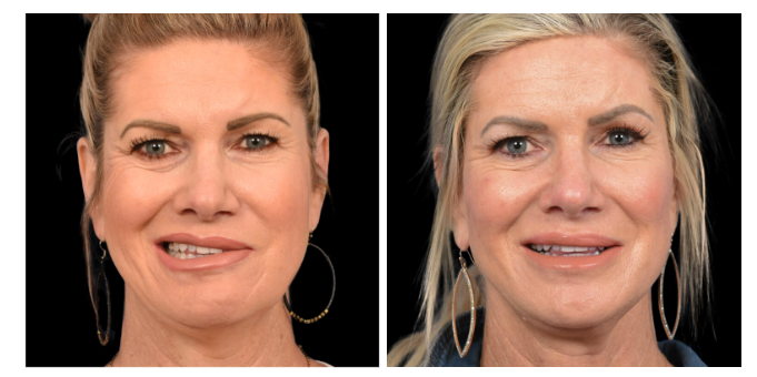 facial reanimation surgery before and after facial symmetry improvement