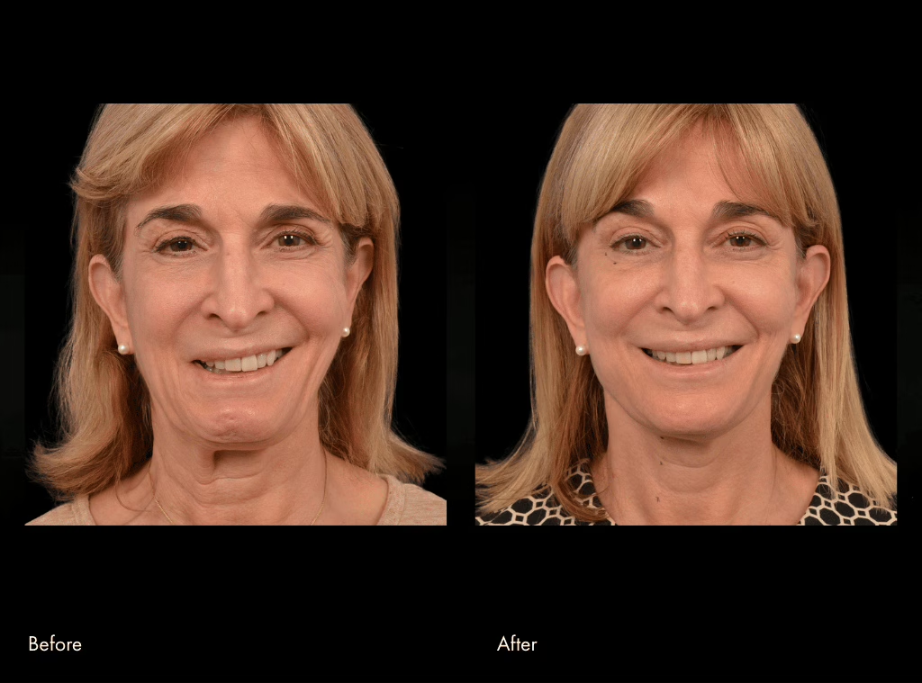 Fourth facial reanimation surgery before and after