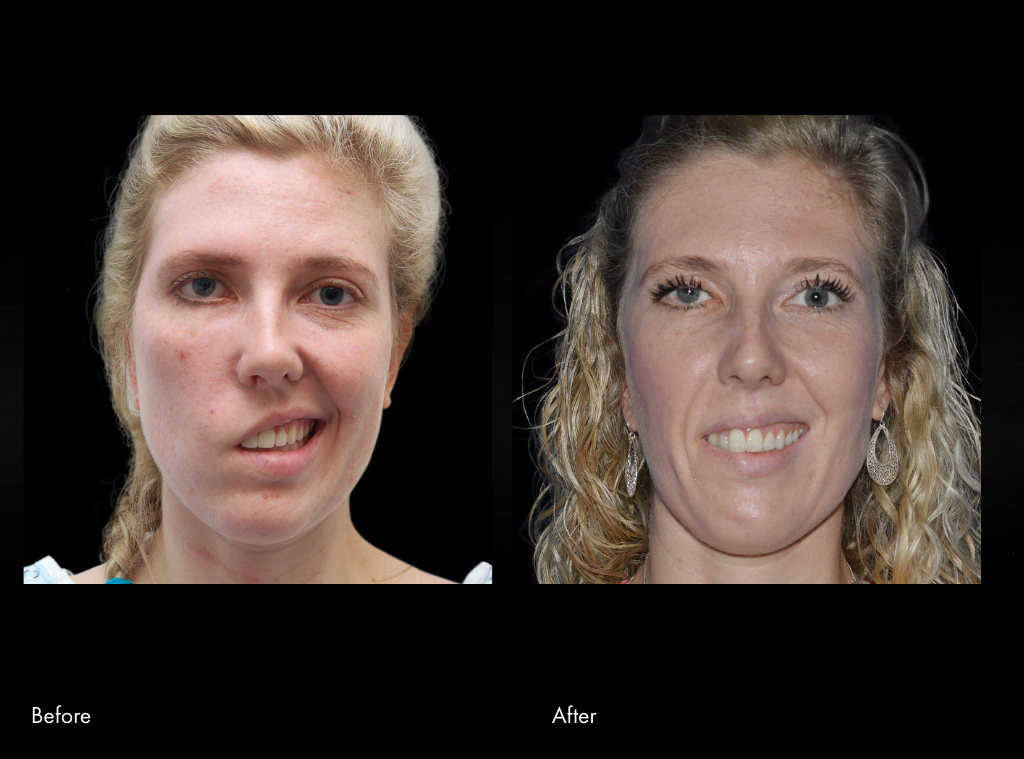 Masseter Nerve Transfer before and after