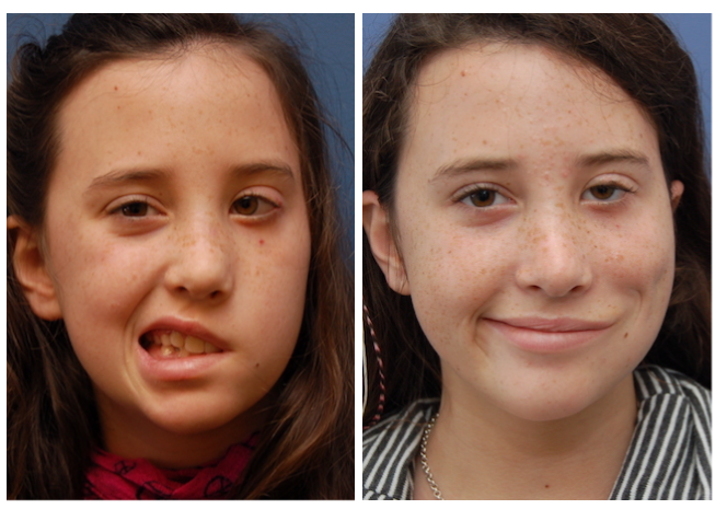 facial reanimation surgery before and after gracilis muscle transfer