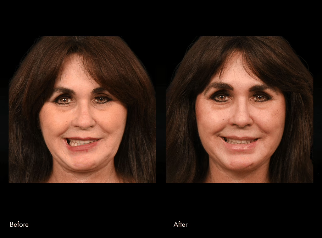 First facial reanimation surgery before and after