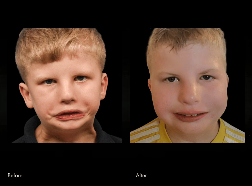 Pediatric facial reanimation surgery before and after