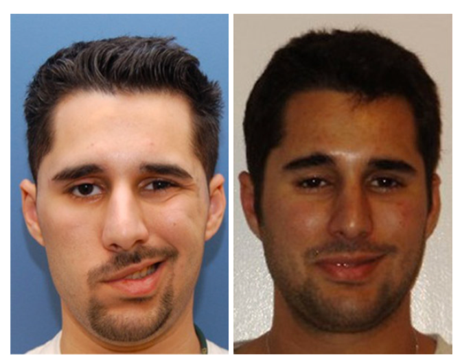 facial reanimation surgery before and after facial reconstruction