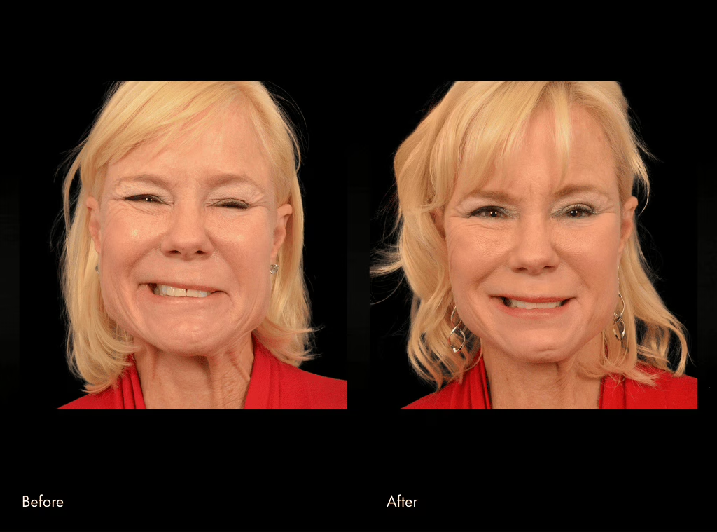 Third facial reanimation surgery before and after