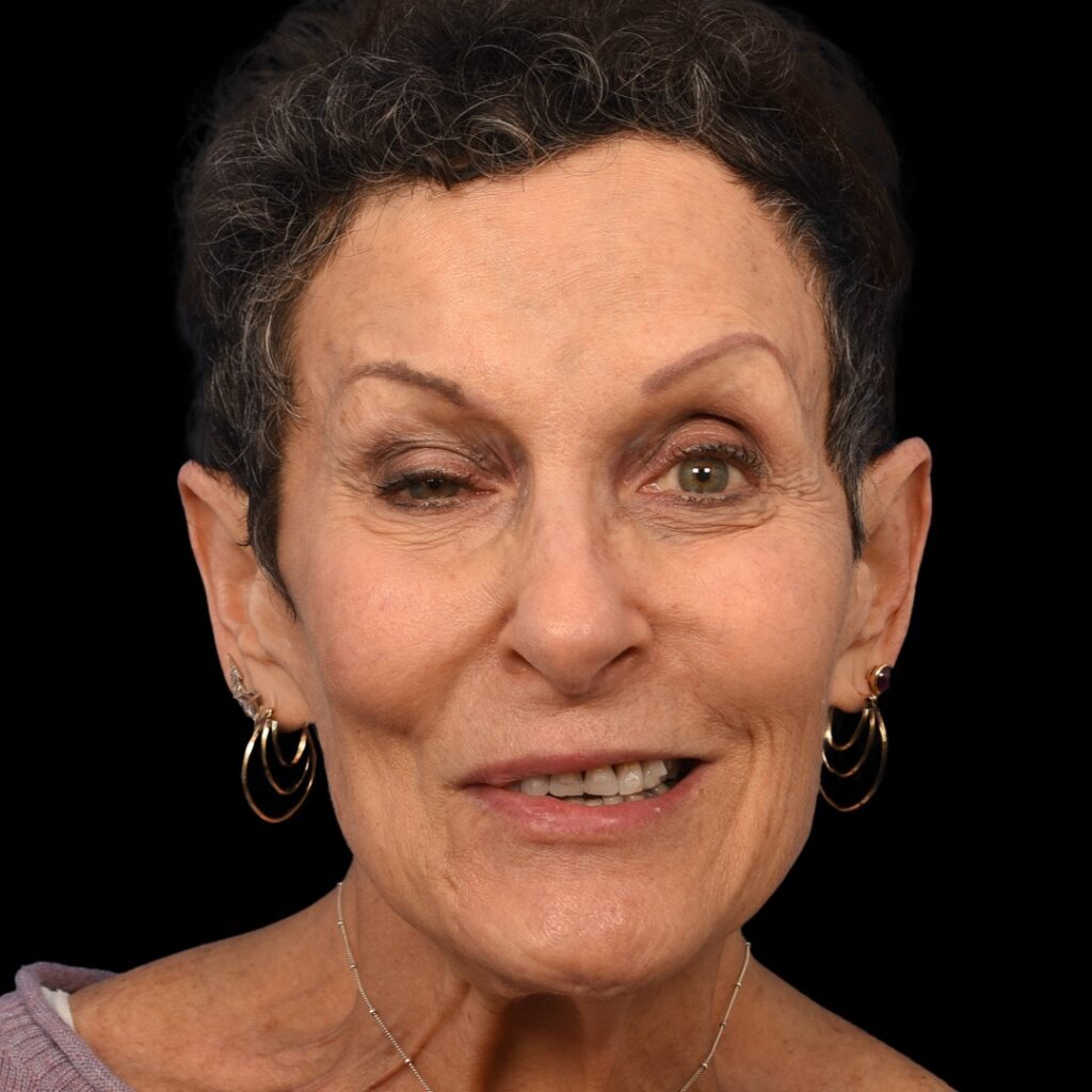 Close-up illustration of facial nerve inflammation in Bell's palsy