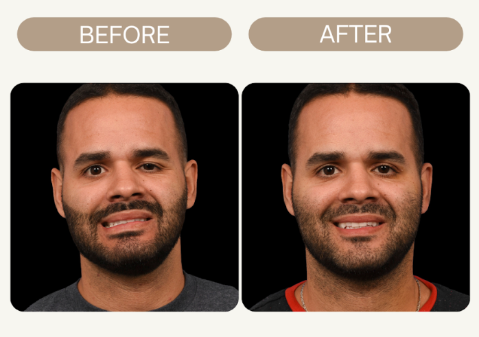 before and after facial symmetry