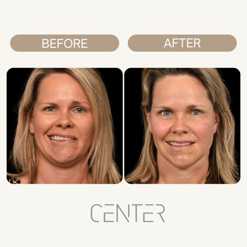 Bell’s Palsy Patient who went through surgery