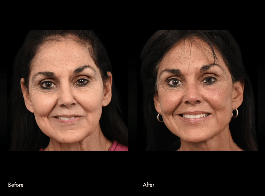 Before and After Surgery by Dr Babak Azzizzadeh