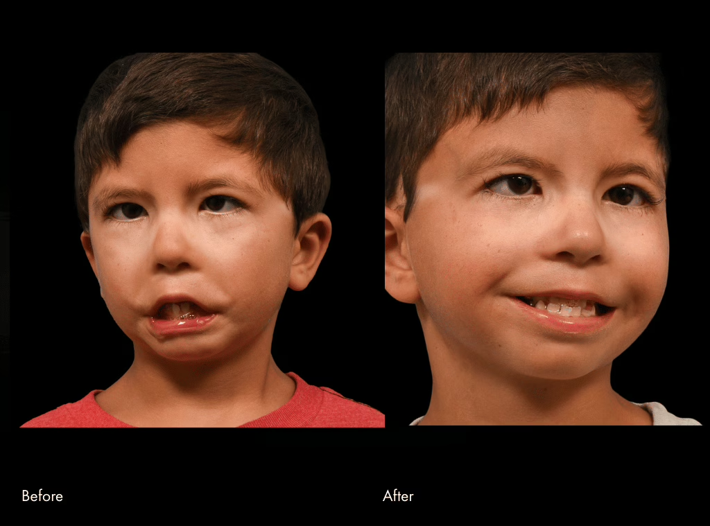 Child Before and After Facial Surgery