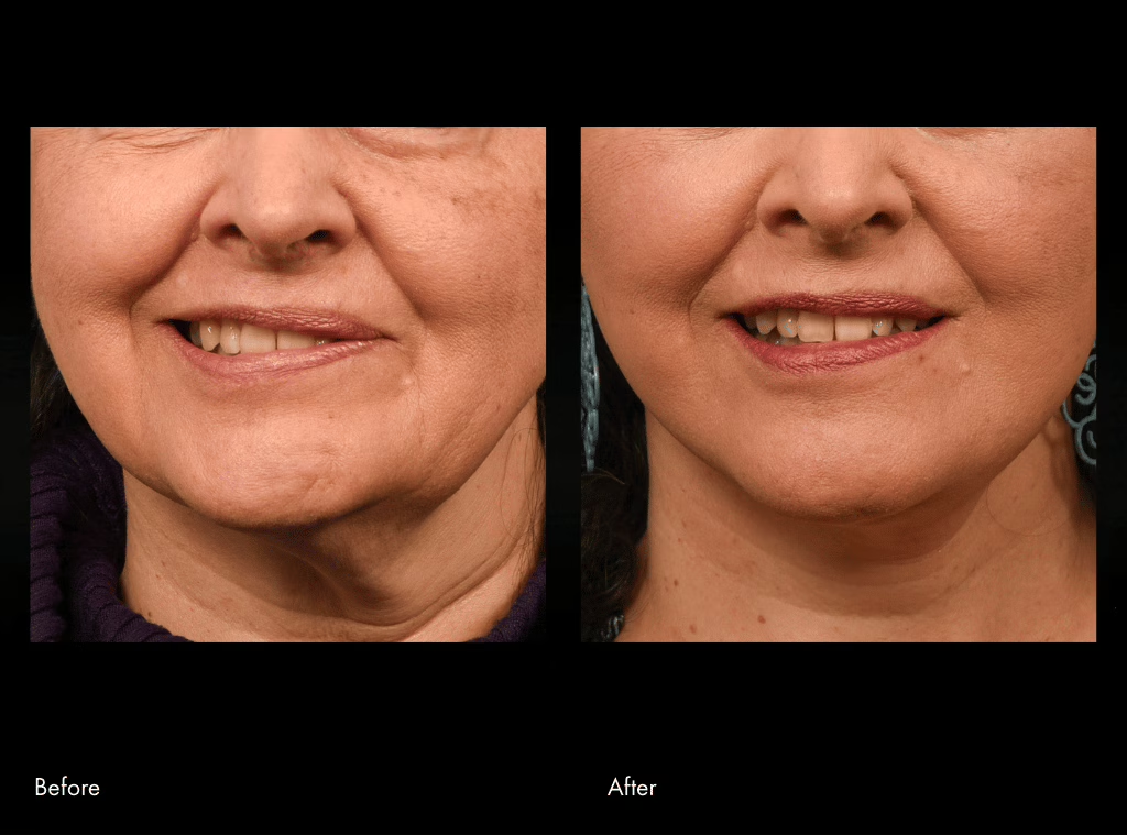 Before and after selective neurolysis two