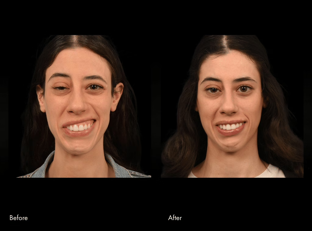 Before and after selective neurolysis