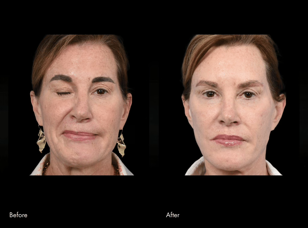 Before and After Facial Paralysis Surgery