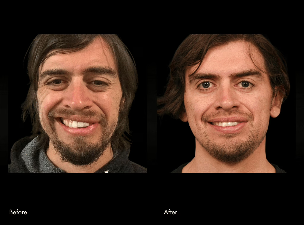 Before and After Surgery