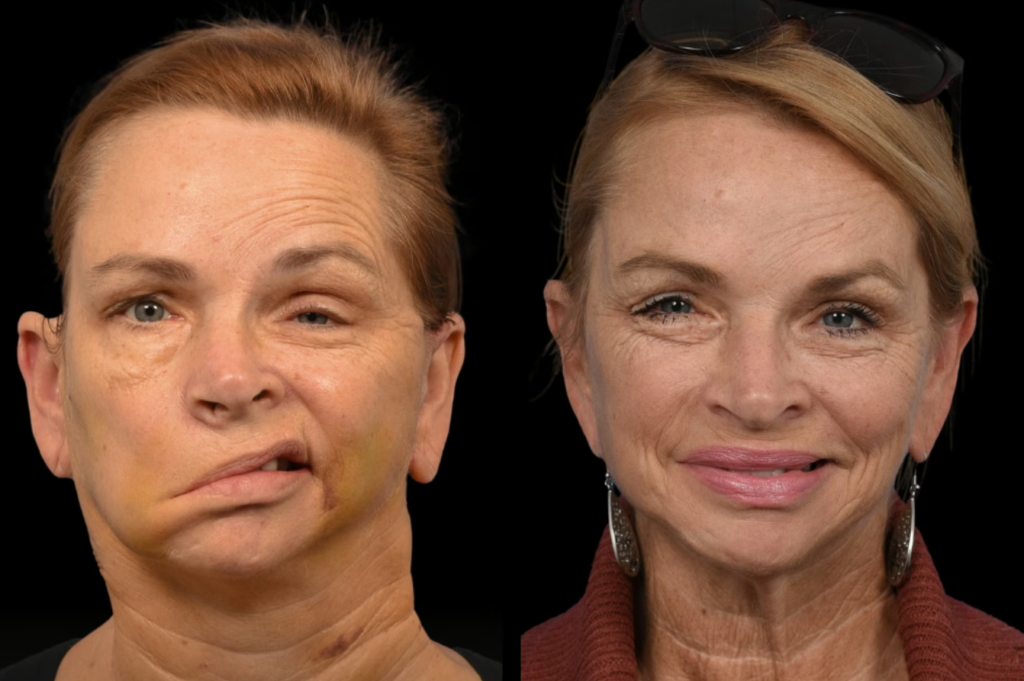 before and after facial nerve treatment