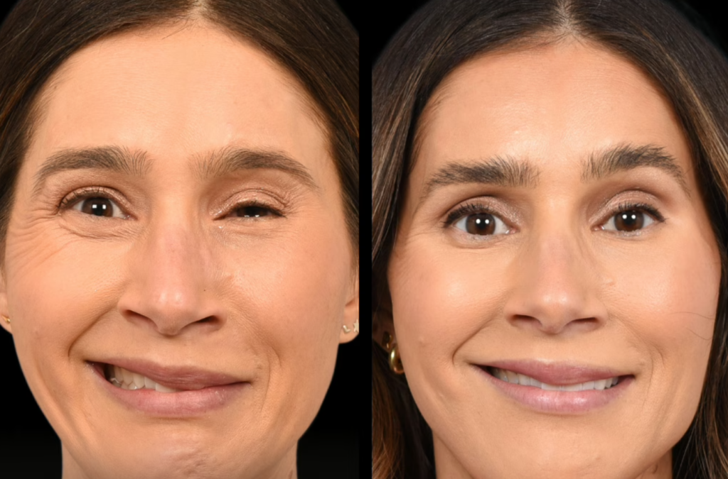 Facial Nerve Regeneration - Bell's Palsy Patient