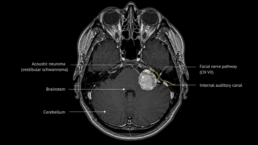 MRI scan showing acoustic neuroma tumor near the brainstem and facial nerve pathway