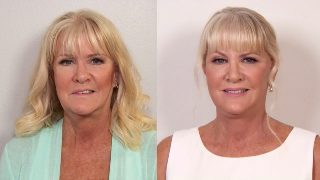 before and after facial reanimation