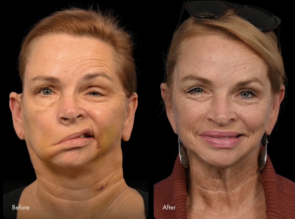 Before and after facial expression following reanimation surgery