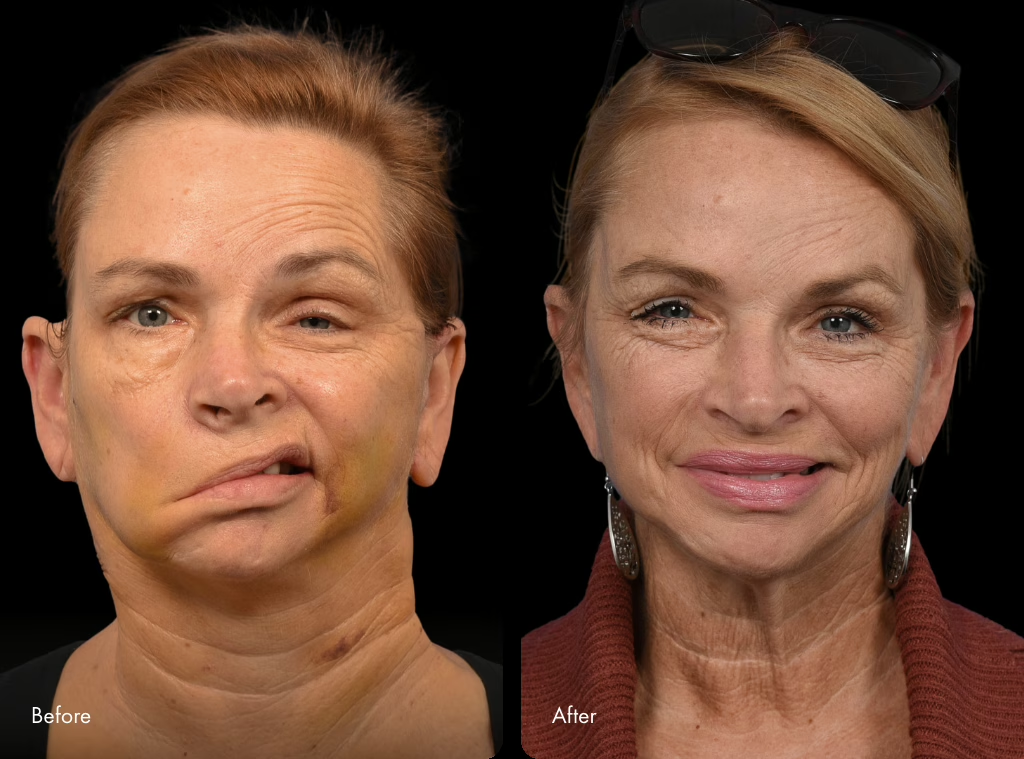 Before/after panel, facial nerve patient